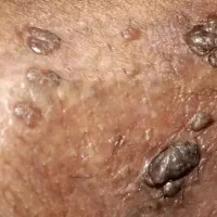 رفع کامل زگیل تناسلی (hpv)