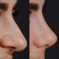 جراحی زیبایی بینی بالاترین کیفیت