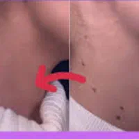 برداشتن انواع خال وزیگل با دستگاه لیزر پیشرفته|خدمات آرایشگری و زیبایی|ارومیه, |دیوار