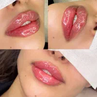 ژل،بوتاکس،لیزر،پی ارپی
