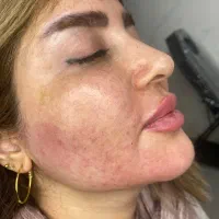 بوتاکس،فیلر،مزوژل باتخفیفی که نمی‌خوای از دست بدی|خدمات آرایشگری و زیبایی|شیراز, میرزاکوچک خان|دیوار