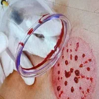 حجامت ماساژ درمانی