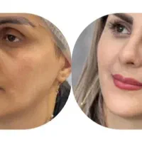 ساکشن غبغب ژل بوتاکس بلفاروپلاستی