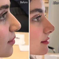 جشنواره ۵۰ درصدی ژل بوتاکس فقط تا سه روز|خدمات آرایشگری و زیبایی|اصفهان, برازنده|دیوار