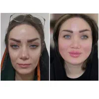 تزریق تخصصی فیلروبوتاکس و آنزیم توسط پزشک|خدمات آرایشگری و زیبایی|کرمانشاه, |دیوار