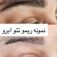 لیزر ریمو تتو بدن ، ابرو ، خط چشم ، خط لب