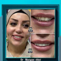 دندانپزشکی زیبایی و درمانی لمینت کامپوزیت دندان|خدمات آرایشگری و زیبایی|شیراز, معالی‌آباد|دیوار