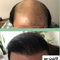 کاشت مو، ابرو، ریش حرفه ای توسط پزشک متخصص پوست مو|خدمات آرایشگری و زیبایی|شیراز, قدوسی غربی|دیوار