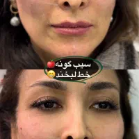ژل لب بوتاکس آنزیم فیلر لیزر پاکسازی پوست فشیال|خدمات آرایشگری و زیبایی|کرج, گوهردشت|دیوار