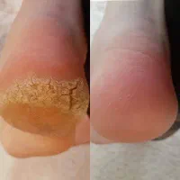 کفسابی پدیکور و رفع تیرگی تخفیف ب مدت ۲ روز|خدمات آرایشگری و زیبایی|فولادشهر, B2|دیوار