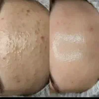 برداشتن خال زگیل‌ کک مک و فشیال، پروتیین و تاتو