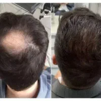 پی آر پی ممنوع