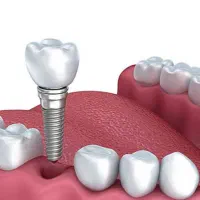 ایمپلنت با شرایط اقساط توسط جراح فک و صورت
