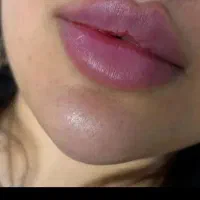 آموزش و تزریق ژل و بوتاکس|خدمات آرایشگری و زیبایی|اسلامشهر, شهرک سالور|دیوار