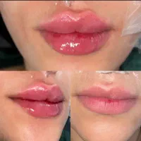 جشنواره تزریق ژل بوتاکس فیلر پی آرپی مطب زیبایی|خدمات آرایشگری و زیبایی|تبریز, |دیوار