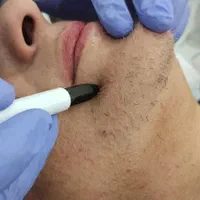 ۱۵٪تخفیف لیزر موهای زائد الکترولیز خالبرداری کربن|خدمات آرایشگری و زیبایی|فولادشهر, B5|دیوار