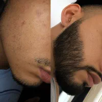 بدون کاشت ریش جذاب شو