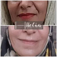 تزریق تخصصی فیلر|خدمات آرایشگری و زیبایی|شیراز, تندگویان|دیوار