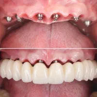 دندانپزشکی ایمپلنت دیجیتال و فوری با اقساط بلندمدت|خدمات آرایشگری و زیبایی|تبریز, |دیوار