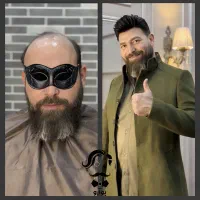 پروتز مو « وارداتی VIP - جایگزین کاشت مو »