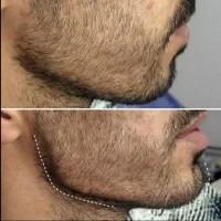 لیزر ،تاتو|خدمات زیبایی و سلامت|کرمانشاه, |دیوار