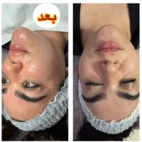 فیشال، اسکالپ اسکراب، هداسپا، ریزش مو