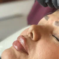 لیزرموهای زائدگلسازرشت تخفیف تااخرهفته