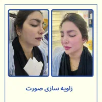 فیلر لب روسی -زاویه سازی -بوتاکس-پی ار پی -مزو|خدمات آرایشگری و زیبایی|تهران, دریا|دیوار