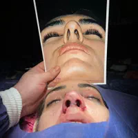 جراحی بینی و پلک|خدمات آرایشگری و زیبایی|قم, انسجام|دیوار