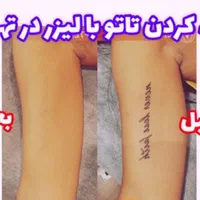رفع تاتوروشن‌سازی زیربغل کربن تراپی مطب دکترموسوی|خدمات آرایشگری و زیبایی|تهران, فردوس|دیوار