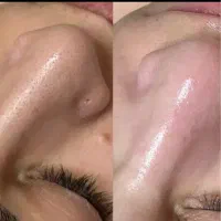 فیشیال تخصص پوست وصورت