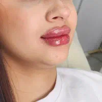 تخفیف ویژه بوتاکس،فیلر،مزو،لیزر موهای زائد کندلا