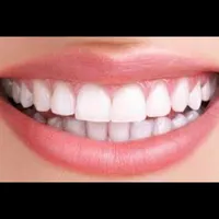 تخفیف ۹ میلیونی دندان برای کامپوزیت