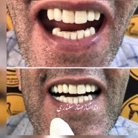 دندانسازی سکندری کرمان دندان ایتالیایی لثه نرم|خدمات آرایشگری و زیبایی|کرمان, |دیوار