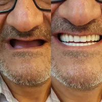 دندان مصنوعی طرح لمینیت کاملا طبیعی
