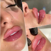 تزریق ژل لب روسی m مادلینگ /بوتاکس /فیلر بادی