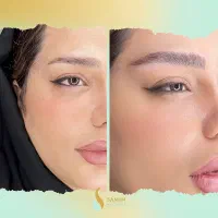 مدل میکروبلیدینگ/میکرونچرال/فیبروز/تینت/شیدینگ