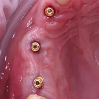 دندانپزشکی ایمپلنت دیجیتال ارتودنسی کامپوزیت لمینت|خدمات آرایشگری و زیبایی|شبستر, |دیوار