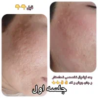 لک جوش و منافذ و جای جوش و لیفت و جوانسازی صورت|خدمات آرایشگری و زیبایی|زاهدان, |دیوار