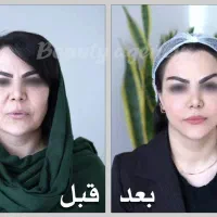 MACS LiFT/لیفت صورت/بلفارو/جوانسازی نچرال/عمل بینی