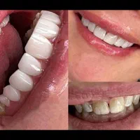 خدمات زیبایی دندان|خدمات آرایشگری و زیبایی|مشکین‌دشت, |دیوار