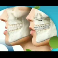 تجربه گرفتن برای عمل فک