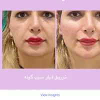 جشنواره تابستانه بوتاکس خال لاغری مزو‌ موفرسیما|خدمات آرایشگری و زیبایی|همدان, |دیوار