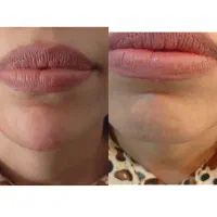 تزریق ژل و بوتاکس .کاشت ناخن.پیرسینگ|خدمات زیبایی و سلامت|کرمانشاه, |دیوار
