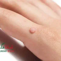 محلول درمان زگیل تناسلی و انواع زگیل