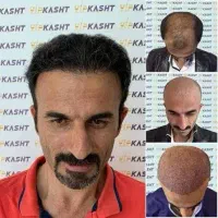 کلینیک کاشت مو تخصصی تخفیف ویژه