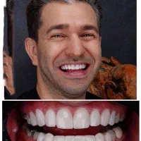 جشنواره ونیر کامپوزیت لمینیت روکش دندان عصب IPS