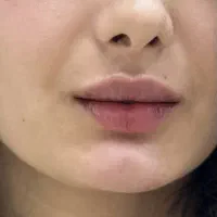 تزریق ژل و بوتاکس و مزوژل