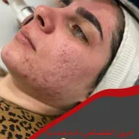درمان کدری،جای جوش و جوانسازی با فیشیال تخصصی