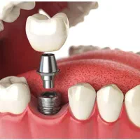 ایمپلنت‌ کره ای ۱۵ میلیون با روکش